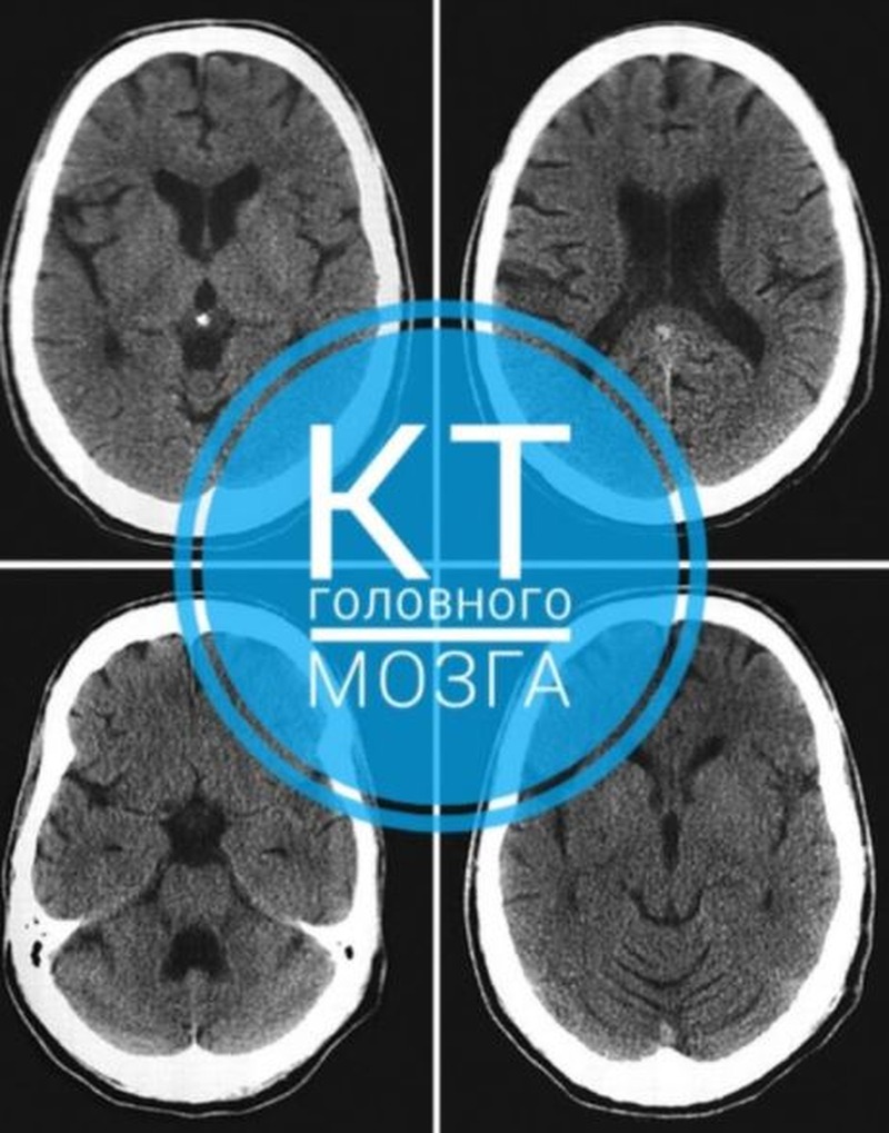 Компьютерная томография головного мозга - медицинский центр «МареМед»