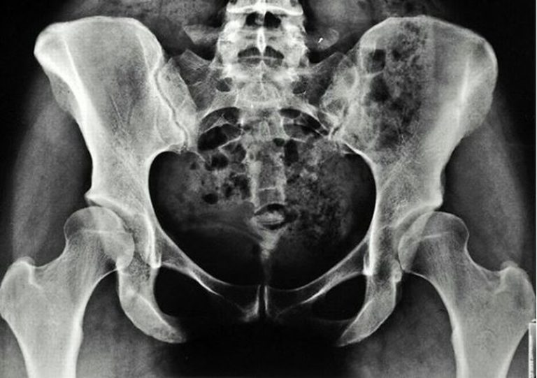 Рентгенография костей таза - медицинский центр «МареМед»